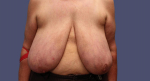 Breast Reduction 6 Before